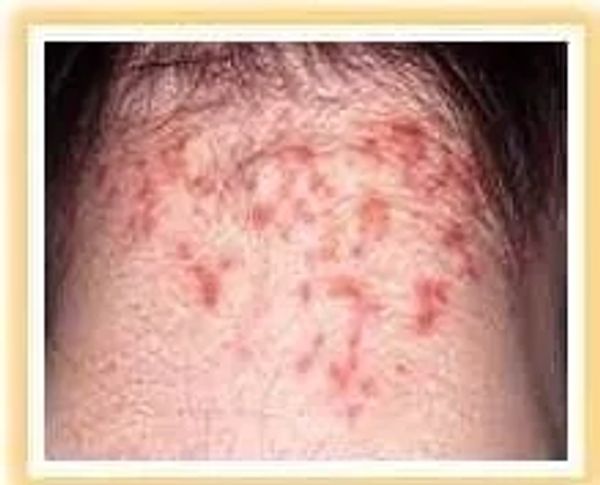 Head Lice Removal Advanced Dermatology Specialists
